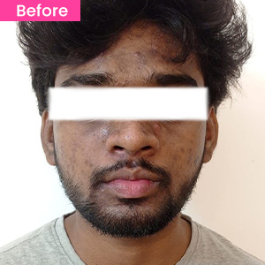 Chemical Peel Treatment Before Image